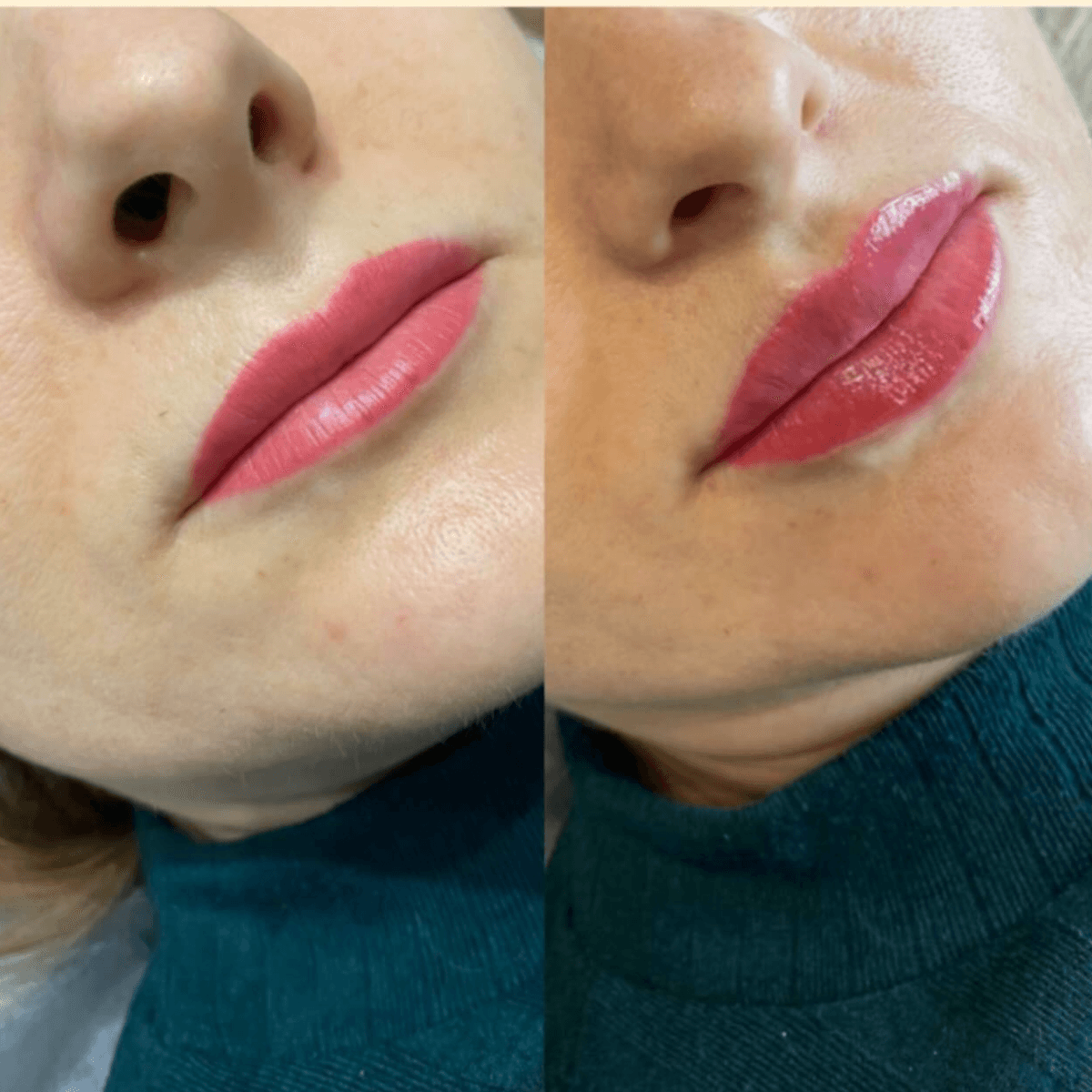 Фото до и после увеличения губ 3