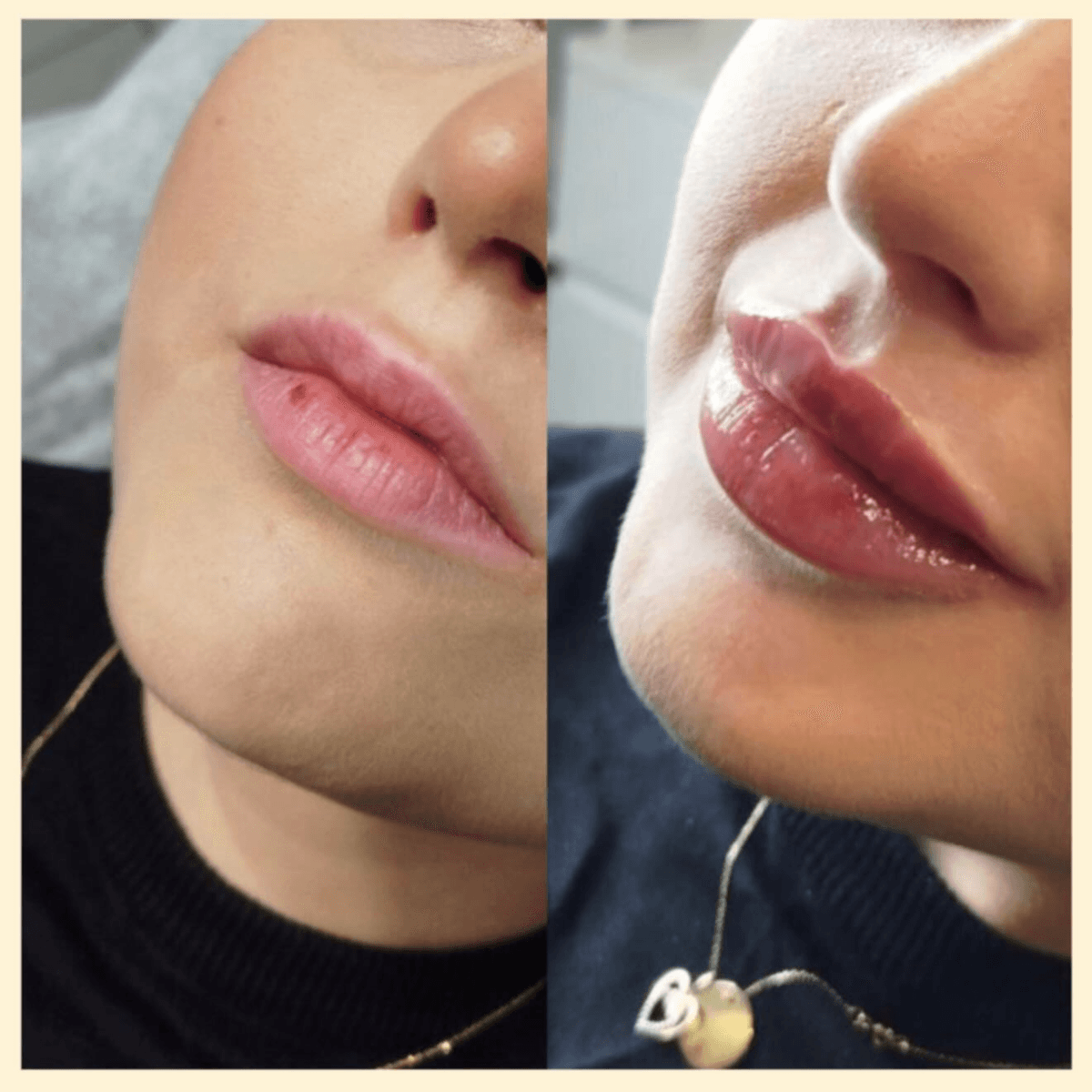 Фото до и после увеличения губ 2