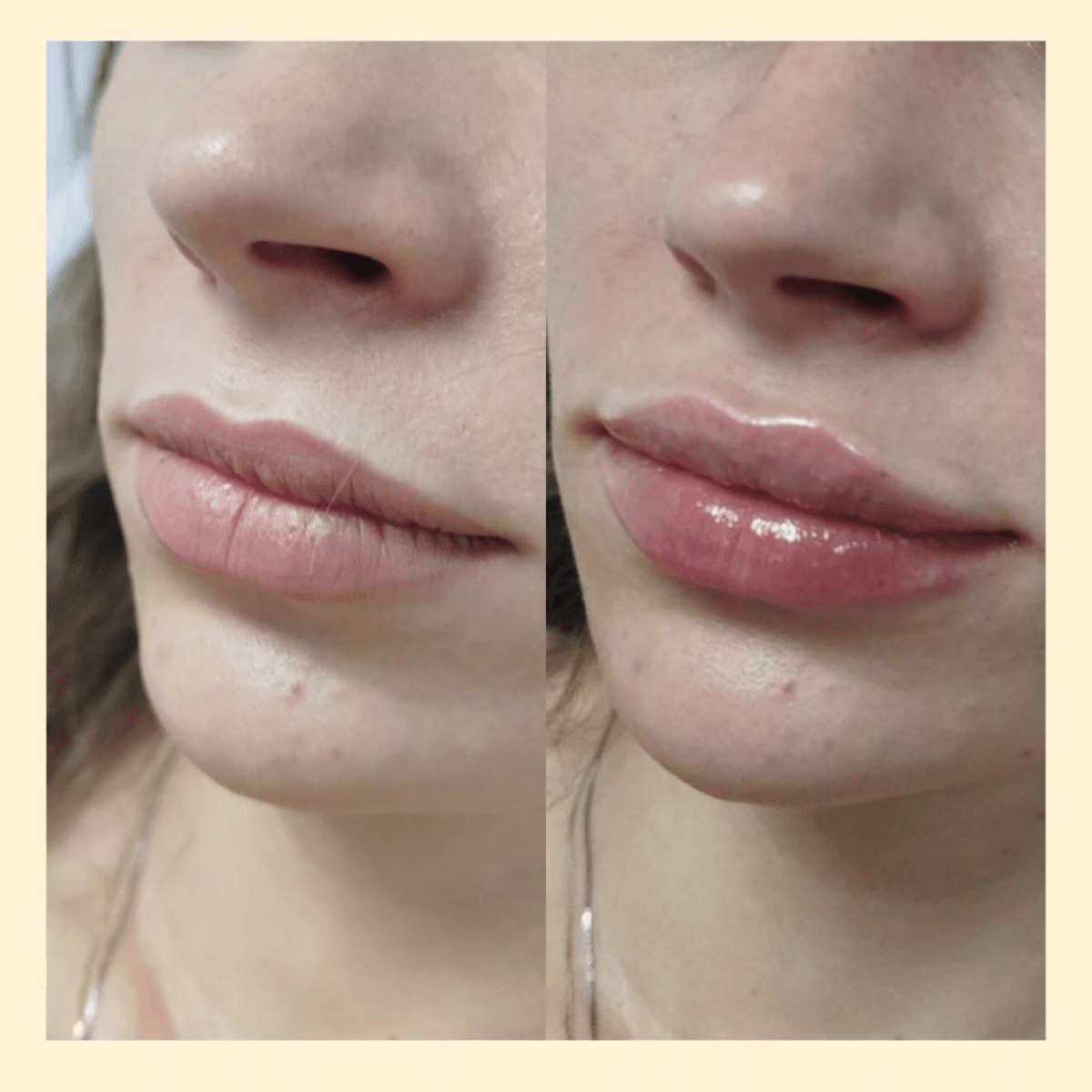 Фото до и после увеличения губ 7