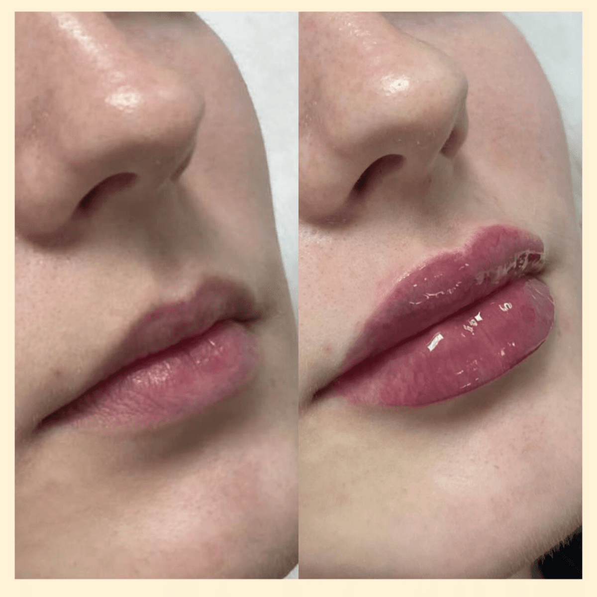 Фото до и после увеличения губ 8