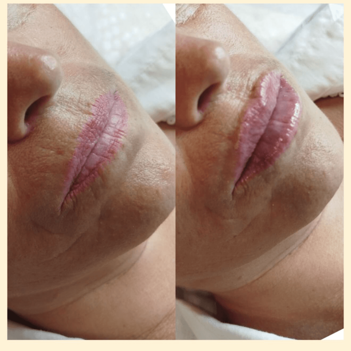 Фото до и после увеличения губ 9